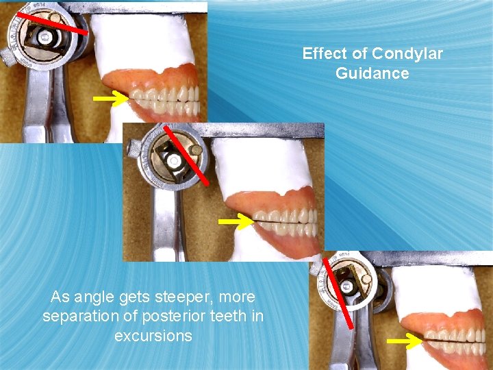 Effect of Condylar Guidance As angle gets steeper, more separation of posterior teeth in