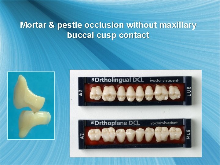 Mortar & pestle occlusion without maxillary buccal cusp contact 