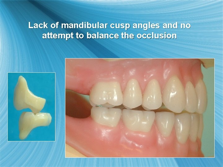 Lack of mandibular cusp angles and no attempt to balance the occlusion 