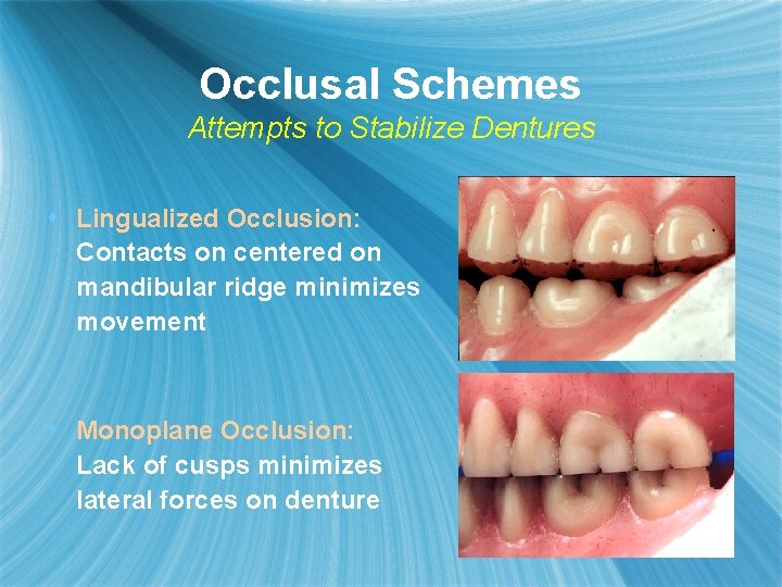 Occlusal Schemes Attempts to Stabilize Dentures s Lingualized Occlusion: Contacts on centered on mandibular