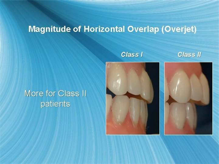 Magnitude of Horizontal Overlap (Overjet) Class I More for Class II patients Class II