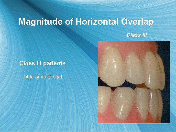 Magnitude of Horizontal Overlap Class III patients Little or no overjet 