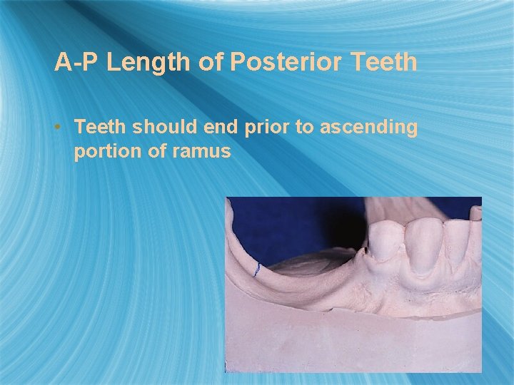 A-P Length of Posterior Teeth • Teeth should end prior to ascending portion of