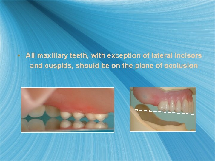  • All maxillary teeth, with exception of lateral incisors and cuspids, should be