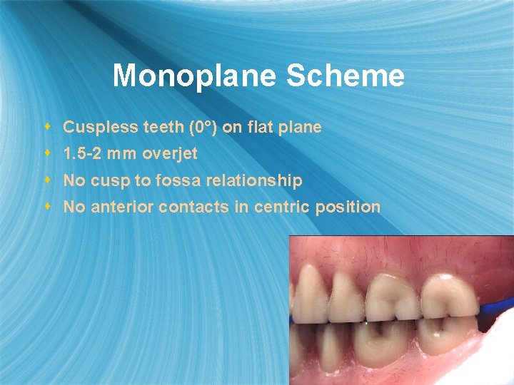 Monoplane Scheme s Cuspless teeth (0°) on flat plane s 1. 5 -2 mm
