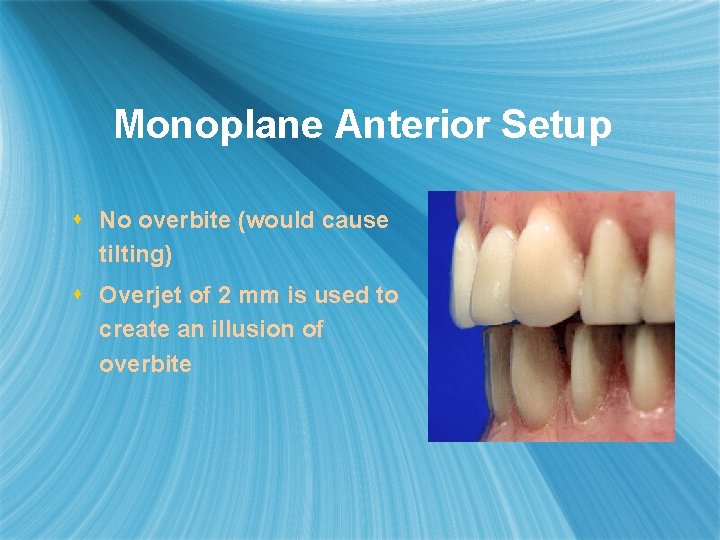 Monoplane Anterior Setup s No overbite (would cause tilting) s Overjet of 2 mm