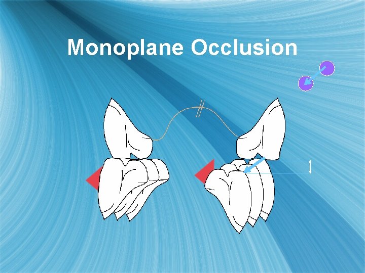 Monoplane Occlusion 