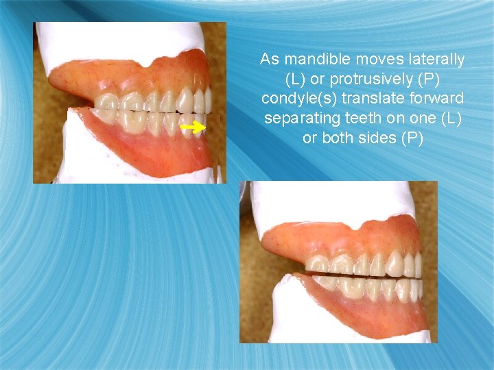 As mandible moves laterally (L) or protrusively (P) condyle(s) translate forward separating teeth on