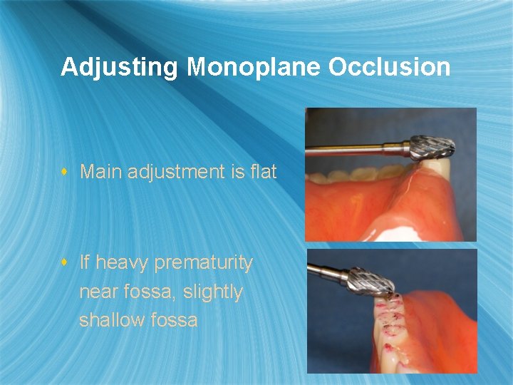 Adjusting Monoplane Occlusion s Main adjustment is flat s If heavy prematurity near fossa,