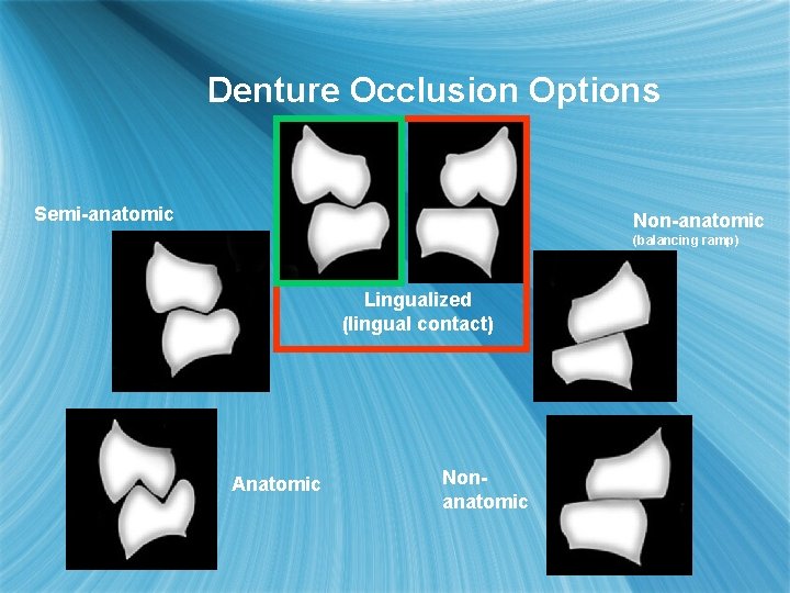 Denture Occlusion Options Semi-anatomic Non-anatomic (balancing ramp) Lingualized (lingual contact) Anatomic Nonanatomic 