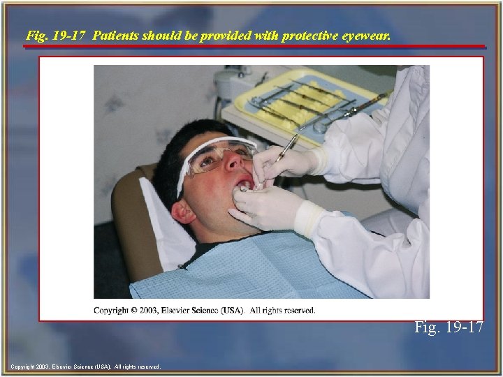 Fig. 19 -17 Patients should be provided with protective eyewear. Fig. 19 -17 Copyright