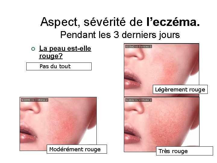 Aspect, sévérité de l’eczéma. Pendant les 3 derniers jours La peau est-elle rouge? Pas