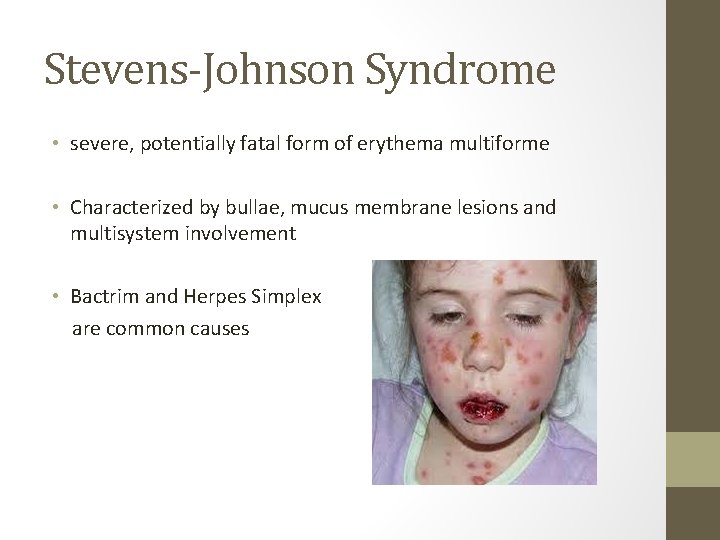 Stevens-Johnson Syndrome • severe, potentially fatal form of erythema multiforme • Characterized by bullae, Stevens-Johnson Syndrome • severe, potentially fatal form of erythema multiforme • Characterized by bullae,