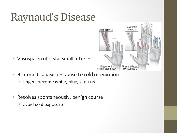 Raynaud’s Disease • Vasospasm of distal small arteries • Bilateral triphasic response to cold Raynaud’s Disease • Vasospasm of distal small arteries • Bilateral triphasic response to cold