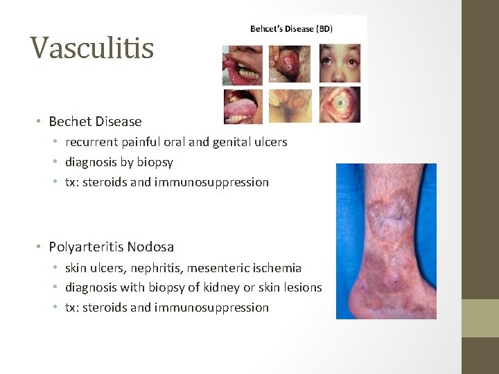 Vasculitis • Bechet Disease • recurrent painful oral and genital ulcers • diagnosis by Vasculitis • Bechet Disease • recurrent painful oral and genital ulcers • diagnosis by