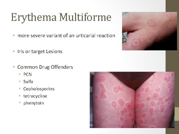 Erythema Multiforme • more severe variant of an urticarial reaction • Iris or target Erythema Multiforme • more severe variant of an urticarial reaction • Iris or target
