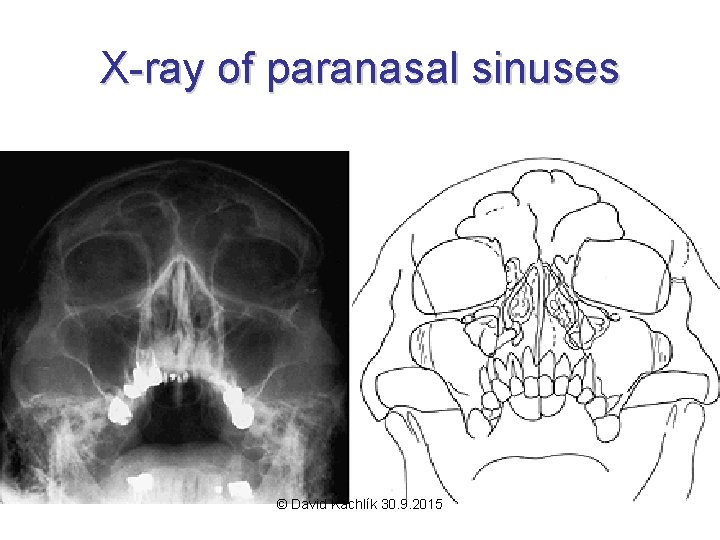 X-ray of paranasal sinuses © David Kachlík 30. 9. 2015 