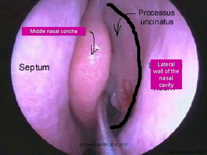 Middle nasal concha Lateral wall of the nasal cavity © David Kachlík 30. 9.