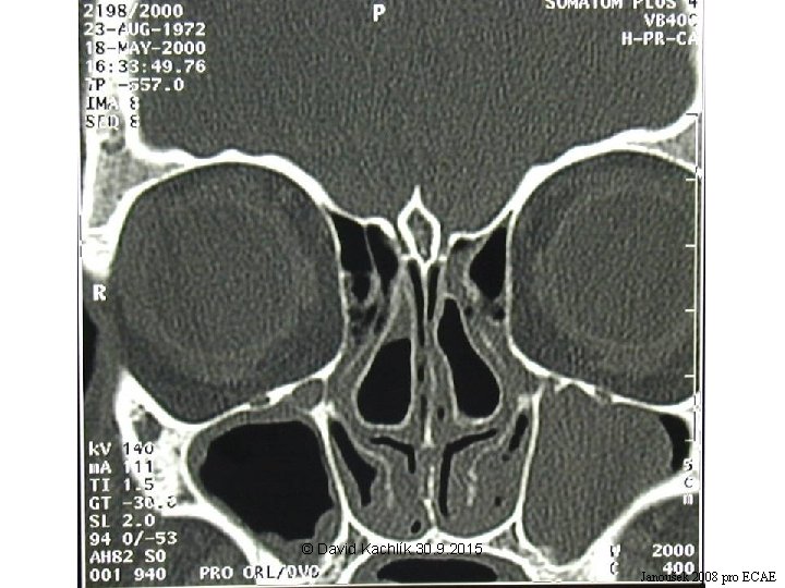 © David Kachlík 30. 9. 2015 Janoušek 2008 pro ECAE 