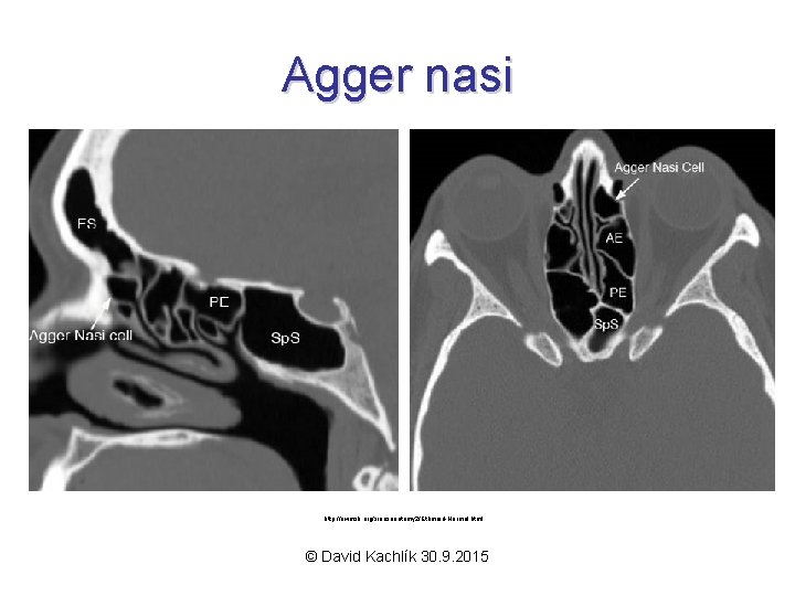 Agger nasi http: //uwmsk. org/sinusanatomy 2/Ethmoid-Normal. html © David Kachlík 30. 9. 2015 