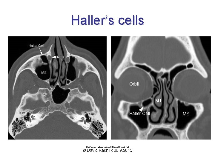 Haller‘s cells http: //uwmsk. org/sinusanatomy 2/Ethmoid-Normal. html © David Kachlík 30. 9. 2015 