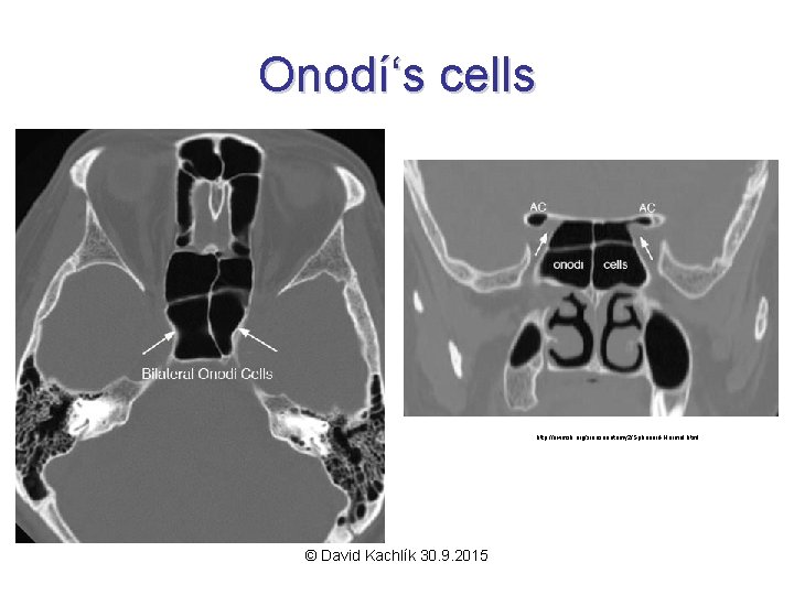 Onodí‘s cells http: //uwmsk. org/sinusanatomy 2/Sphenoid-Normal. html © David Kachlík 30. 9. 2015 