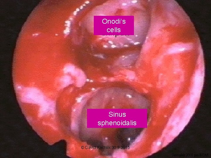 Onodi‘s cells Sinus sphenoidalis © David Kachlík 30. 9. 2015 Janoušek 2008 pro ECAE