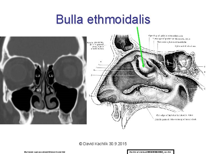 Bulla ethmoidalis © David Kachlík 30. 9. 2015 http: //uwmsk. org/sinusanatomy 2/Ethmoid-Normal. html http: