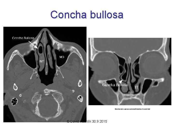 Concha bullosa http: //uwmsk. org/sinusanatomy 2/Maxillary-Normal. html © David Kachlík 30. 9. 2015 