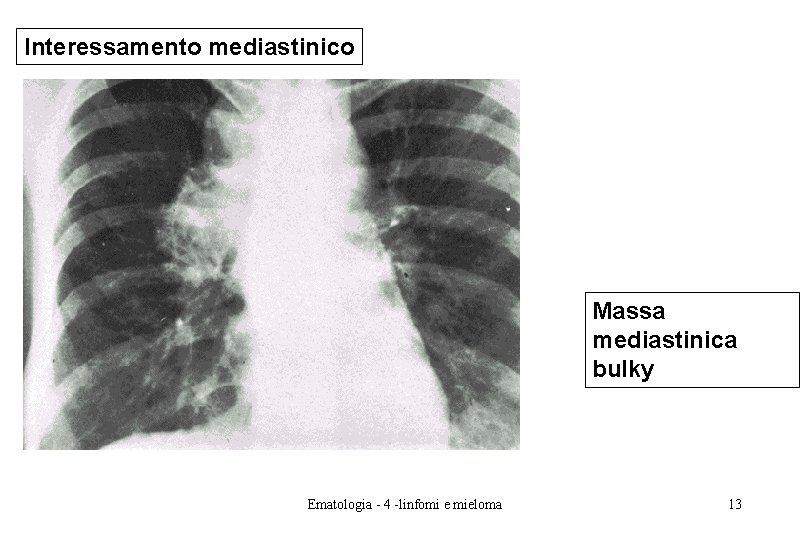 Interessamento mediastinico Massa mediastinica bulky Ematologia - 4 -linfomi e mieloma 13 Interessamento mediastinico Massa mediastinica bulky Ematologia - 4 -linfomi e mieloma 13