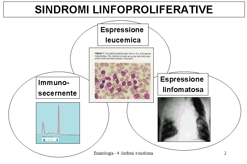 SINDROMI LINFOPROLIFERATIVE Espressione leucemica Espressione linfomatosa Immunosecernente Ematologia - 4 -linfomi e mieloma 2 SINDROMI LINFOPROLIFERATIVE Espressione leucemica Espressione linfomatosa Immunosecernente Ematologia - 4 -linfomi e mieloma 2