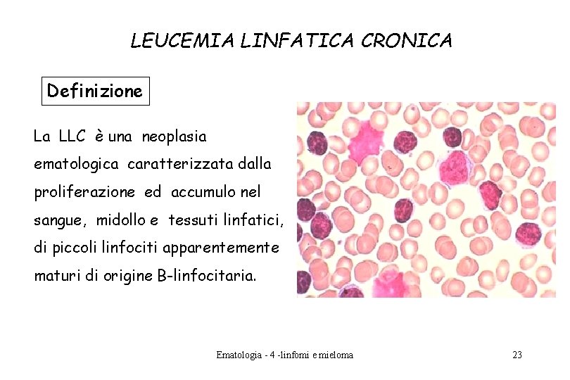 LEUCEMIA LINFATICA CRONICA Definizione La LLC è una neoplasia ematologica caratterizzata dalla proliferazione ed LEUCEMIA LINFATICA CRONICA Definizione La LLC è una neoplasia ematologica caratterizzata dalla proliferazione ed