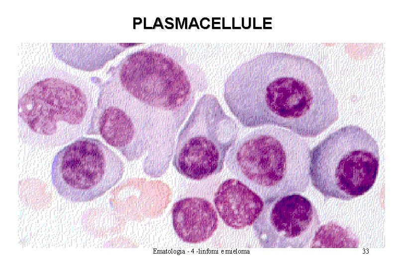 PLASMACELLULE Ematologia - 4 -linfomi e mieloma 33 PLASMACELLULE Ematologia - 4 -linfomi e mieloma 33