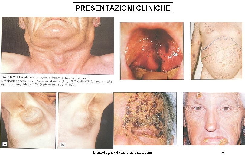 PRESENTAZIONI CLINICHE Ematologia - 4 -linfomi e mieloma 4 PRESENTAZIONI CLINICHE Ematologia - 4 -linfomi e mieloma 4
