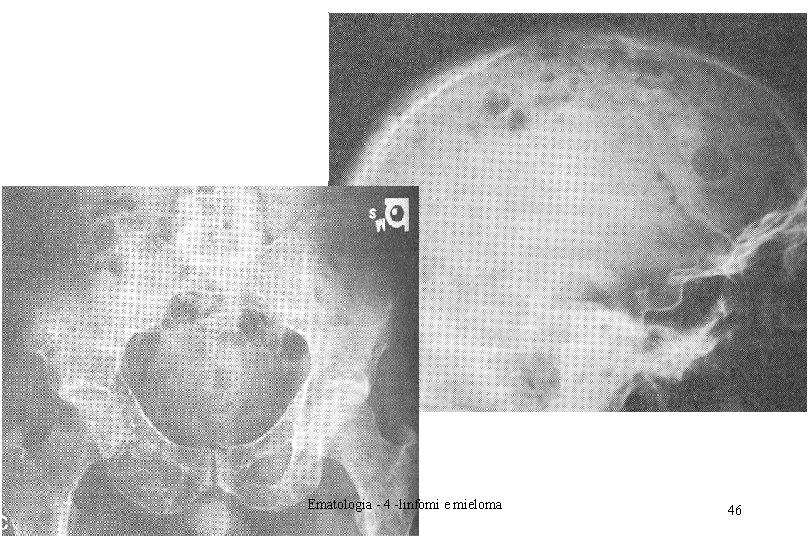 Ematologia - 4 -linfomi e mieloma 46 Ematologia - 4 -linfomi e mieloma 46