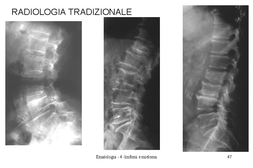 RADIOLOGIA TRADIZIONALE Ematologia - 4 -linfomi e mieloma 47 RADIOLOGIA TRADIZIONALE Ematologia - 4 -linfomi e mieloma 47