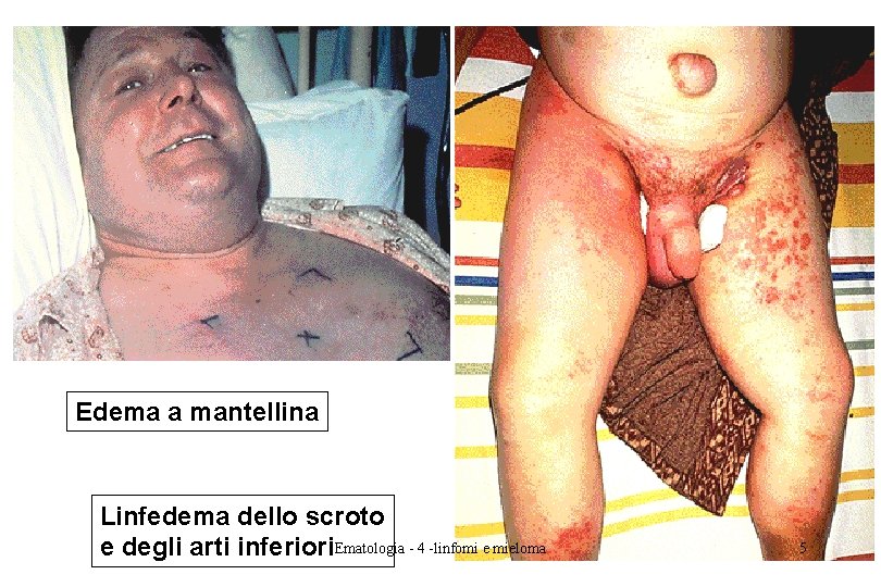 Edema a mantellina Linfedema dello scroto e degli arti inferiori. Ematologia - 4 -linfomi Edema a mantellina Linfedema dello scroto e degli arti inferiori. Ematologia - 4 -linfomi