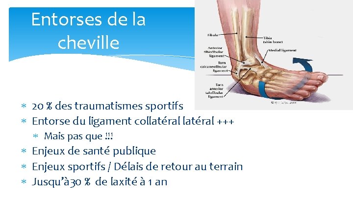Entorses de la cheville 20 % des traumatismes sportifs Entorse du ligament collatéral +++