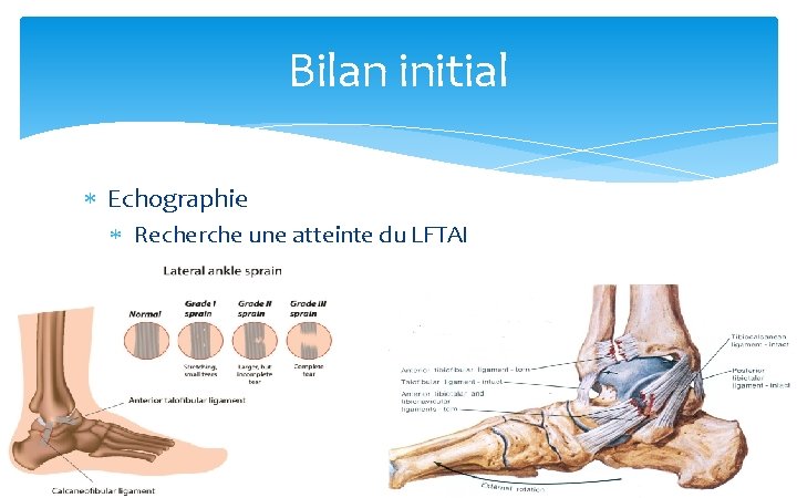 Bilan initial Echographie Recherche une atteinte du LFTAI 