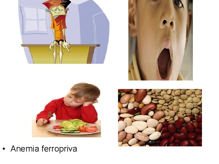  • Anemia ferropriva 