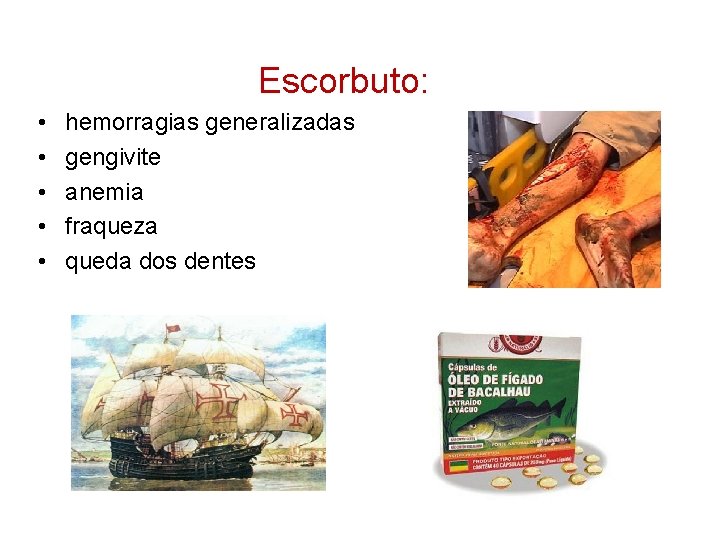  Escorbuto: • • • hemorragias generalizadas gengivite anemia fraqueza queda dos dentes 