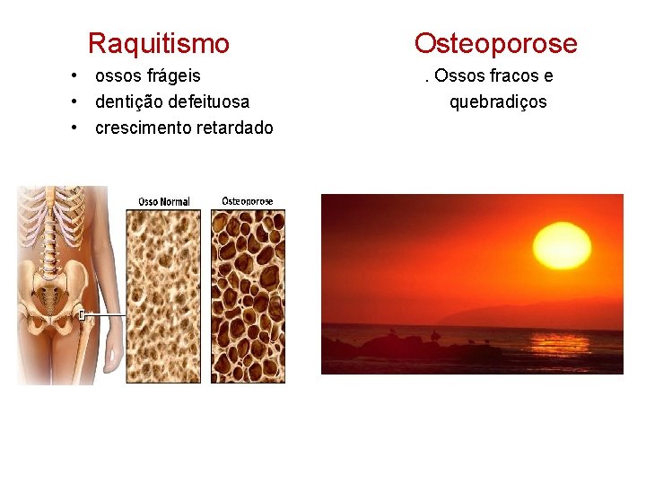  Raquitismo Osteoporose • ossos frágeis . Ossos fracos e • dentição defeituosa quebradiços