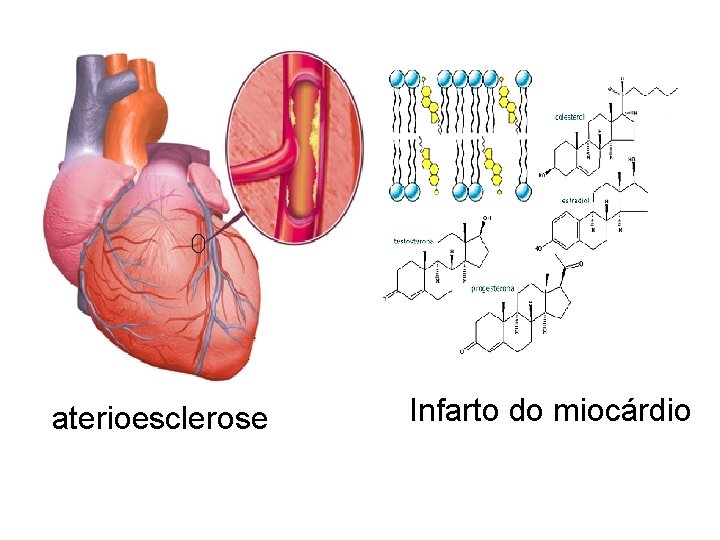  aterioesclerose Infarto do miocárdio 