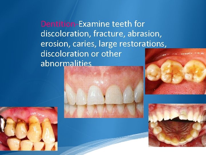 Dentition-Examine teeth for discoloration, fracture, abrasion, erosion, caries, large restorations, discoloration or other abnormalities