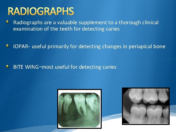 RADIOGRAPHS Radiographs are a valuable supplement to a thorough clinical examination of the teeth