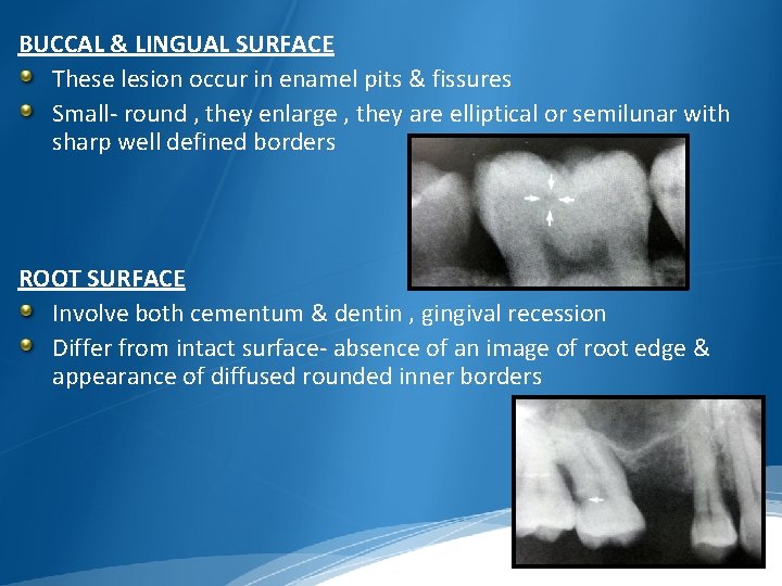 BUCCAL & LINGUAL SURFACE These lesion occur in enamel pits & fissures Small- round