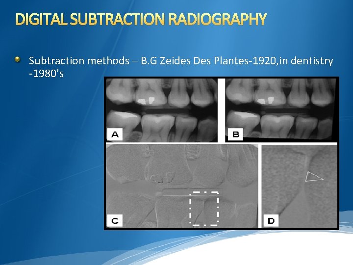 DIGITAL SUBTRACTION RADIOGRAPHY Subtraction methods – B. G Zeides Des Plantes-1920, in dentistry -1980’s
