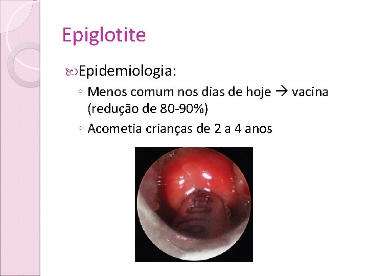 Epiglotite Epidemiologia: ◦ Menos comum nos dias de hoje vacina (redução de 80 -90%)
