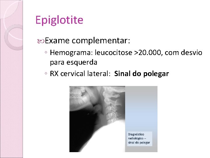 Epiglotite Exame complementar: ◦ Hemograma: leucocitose >20. 000, com desvio para esquerda ◦ RX