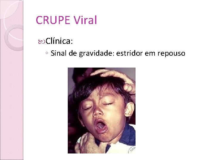 CRUPE Viral Clínica: ◦ Sinal de gravidade: estridor em repouso 